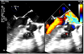 Operative, Echocardiographic and Angiocardiographic Details of an Adult with Subvalvular Aortic Aneurysm with Severe Aortic Regurgitation undergoing Patch Closure of the Aneurysm and Aortic Valve Replacement