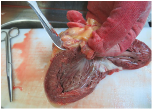 Operative, Echocardiographic and Angiocardiographic Details of an Adult with Subvalvular Aortic Aneurysm with Severe Aortic Regurgitation undergoing Patch Closure of the Aneurysm and Aortic Valve Replacement