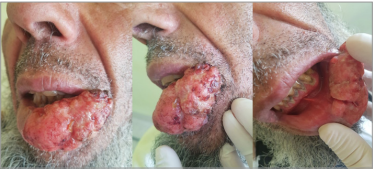 Lower Lip Squamous Cell Carcinoma: Clinical and Dermoscopic Features