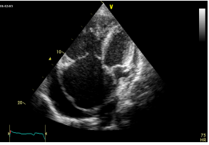 Evaluation of Systolic Function of the Right Ventricle in Patients with Chronic Obstructive Pulmonary Disease: A Cross Sectional Study about 30 Cases