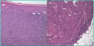 Melanoma metastasis to the testicle: a review of the literature and the case of mistaken identity