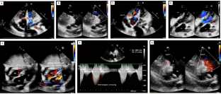 Two Patch Repair of Rastelli’s Type-A Complete Atrioventricular Septal Defect with Relief of Right Ventricular Outfl ow Tract Obstruction under Mild Hypothermic Extracorporeal Circulation and Cardioplegic Arrest: A Video Presentation