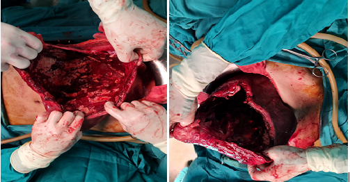 A case of Giant hepatic hydatid cyst