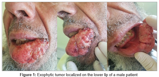 Lower Lip Squamous Cell Carcinoma: Clinical and Dermoscopic Features