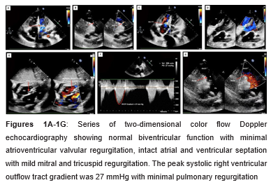 Two Patch Repair of Rastelli’s Type-A Complete Atrioventricular Septal Defect with Relief of Right Ventricular Outflow Tract Obstruction under Mild Hypothermic Extracorporeal Circulation and Cardioplegic Arrest: A Video Presentation