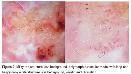 Lower Lip Squamous Cell Carcinoma: Clinical and Dermoscopic Features