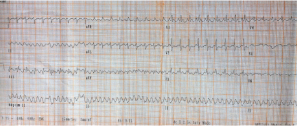 Perinatal Atrial Flutter: Clinical Presentation, Management and Outcome